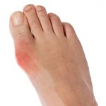 gout-foot